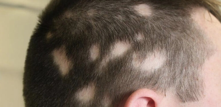 Saç kıran hastalığı nedir? Nasıl bulaşır, tedavi edilmezse ne olur? Kalıcı mı, nasıl geçer?