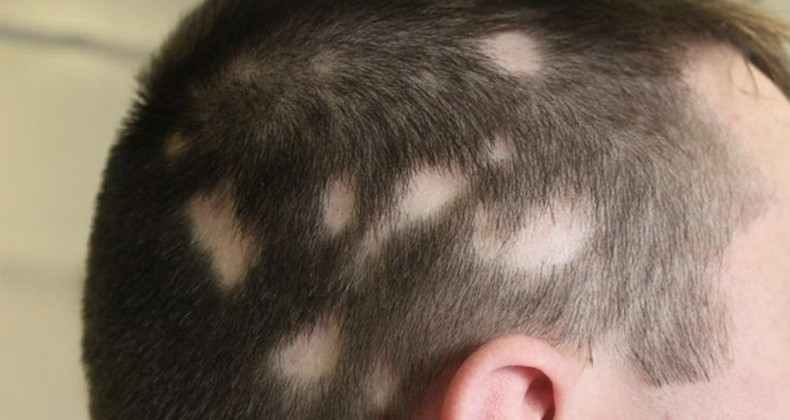Saç kıran hastalığı nedir? Nasıl bulaşır, tedavi edilmezse ne olur? Kalıcı mı, nasıl geçer?